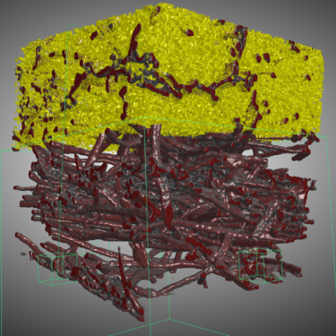 CT scan of PICA