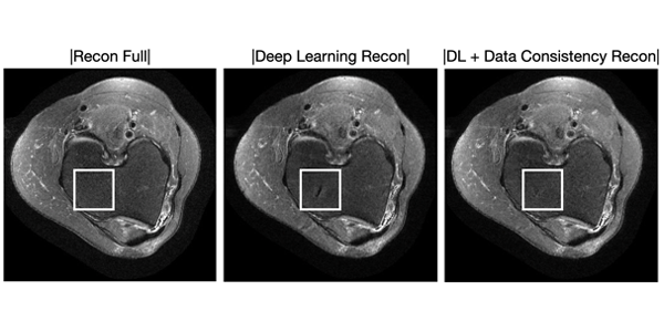 Improved assessment of placenta accreta with fast 3D MRI