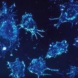 Human cancer cells seen under the microscope