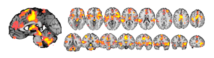 Brain scans from the study